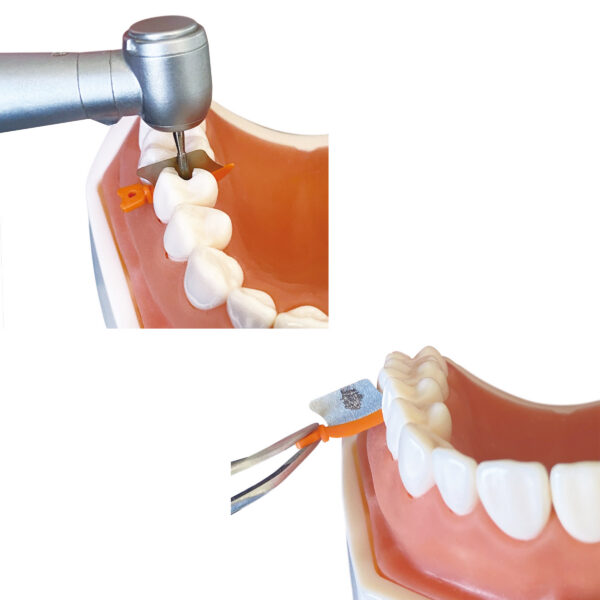 Dental Wedge Guards F2 Medical Supplies